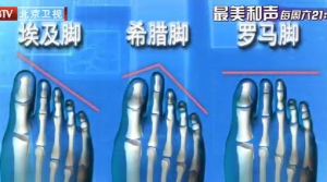 我是大医生20140505视频和笔记:《你选对鞋了吗》埃及脚,希腊脚,罗马脚,腹型肥胖