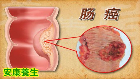 肠癌的发病原因