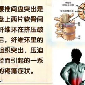 饮食养生汇20140507视频和笔记:康南讲《腰椎间盘突出症揭秘》腰椎间盘突出的治疗