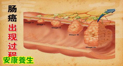 肠癌的出现过程