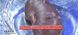 20140513我是大医生视频和笔记:《沉默的肾脏》肾炎,肾癌,尿液返流,肾积水,补肾