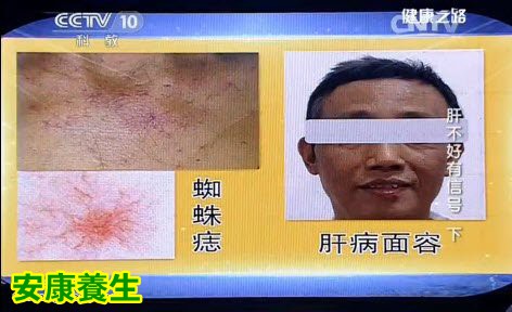 慢性肝病患者多会出现肝掌、蜘蛛痣