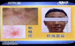 《健康之路》20140611视频和笔记:赵平讲肝不好有信号(下)慢性肝病,肝硬化,肝癌,肝掌