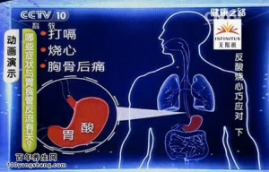 《健康之路》20140615视频和笔记：孙晓红讲反酸烧心巧应对（下）胃食管返流