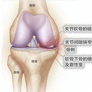 任立敏讲骨关节炎的常见误区、类风湿关节炎与痛风的区别