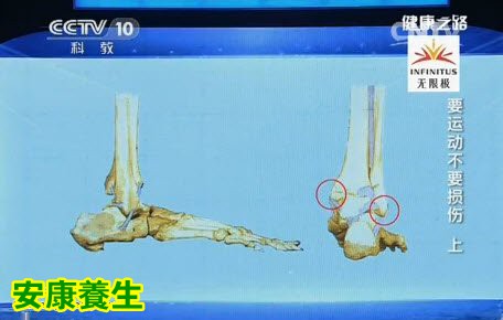 踝关节损伤的主要原因是韧带外侧比内侧薄弱