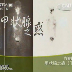 《健康之路》20140708视频笔记:母义明讲甲状腺之惑（下）甲减、甲亢、甲状腺功能检查