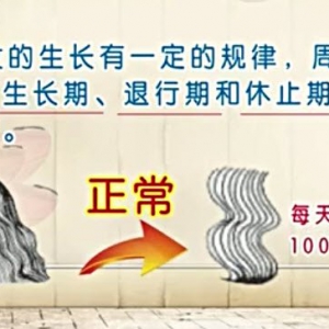 20140724饮食养生汇视频和笔记:何志新讲病理性斑秃,雄激素性脱发,生理性脱发
