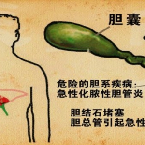 20140802《养生堂》视频,:郭树彬,沈珠军讲急性胆系疾病,胆汁性体质的特征,胆源性胰腺炎