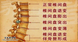 20140814《养生堂》视频和笔记:刘忠军讲腰疼的原因有哪些,腰椎盘突出,高跟鞋的危害