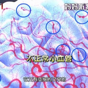 20140923我是大医生视频和笔记:脑中风前兆,脑中风的危险因素,高血压脑病,斑块脱落