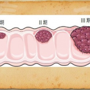 20140928《养生堂》视频和笔记:大肠癌与生活饮食习惯、便秘、肠癌、便血
