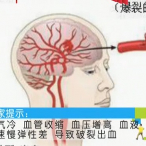 20140930健康生活视频和笔记:预防脑中风食疗方,降三高的降压粥,三根筷子找经脉
