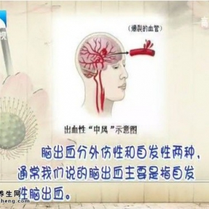 20141010饮食养生汇视频和笔记:李志强讲脑出血症状,脑出血的预防,脑出血的急救