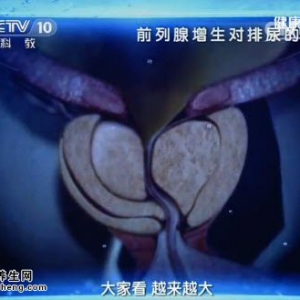 20141017《健康之路》张骞讲前列腺增生的表现、前列腺增生的治疗、前列腺癌