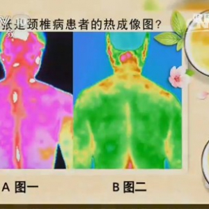 《健康之路》20141103视频和笔记:白一冰讲颈椎病热敷,热敷治疗颈椎病,泡脚的时间多久合适