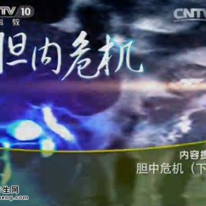 《健康之路》20141106视频笔记:栗光明讲胆囊息肉和哪些因素有关,哪种胆囊息肉容易癌变