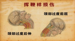 《养生堂》20141128视频:李中实讲颈椎病的预防、颈椎保健操、怎么保护颈椎