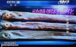 《健康之路》20141217视频和笔记:李虹伟讲高血脂的表现、血脂高的危害、降血脂的方法