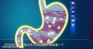 我是大医生20141222视频和笔记:武爱文讲胃癌的原因及治疗 胃溃疡与胃癌的关系