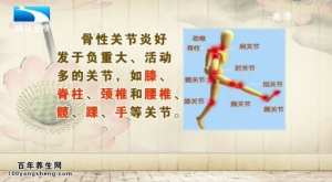饮食养生汇20141225视频和笔记:陈亚平讲骨性关节炎的治疗 骨性关节炎的分类