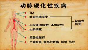 《养生堂》20150210视频笔记:颈动脉狭窄和中风的关系 冠心病和颈动脉狭窄的关系