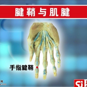 聚健康20150210视频和笔记:什么是腱鞘炎 如何预防腱鞘炎 腱鞘炎的治疗方法