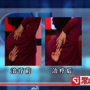 聚健康20150212视频和笔记:肩周炎到底能治愈吗 肩周炎的锻炼方法