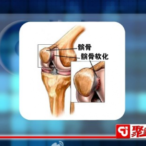 聚健康20150213视频和笔记:造成髌骨软化的原因 如何对髌骨进行保健和治疗