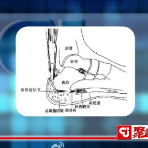 聚健康20150216视频和笔记:足跟痛的常见原因 葛氏捏筋拍打疗法缓解足跟痛
