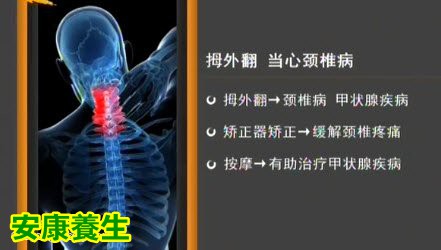 家政女皇20150323视频和笔记:拇外翻导致的疾病 脚趾有硬茧说明身体有什么问题