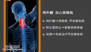家政女皇20150323视频和笔记:拇外翻导致的疾病 脚趾有硬茧说明身体有什么问题