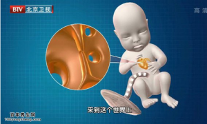 我是大医生20150326视频和笔记:下肢静脉血栓判断 血栓的预防 静脉血栓的高发部位
