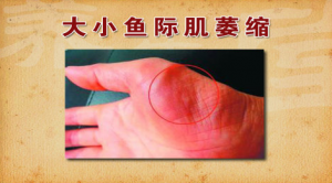 《养生堂》20150407视频笔记:掌纹看疾病 糖尿病并发症的早期表现 神经补充营养的方法