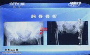 《健康之路》20150407视频笔记:髋关节的典型特点 髋关节异常的判断 髋关节骨折的治疗