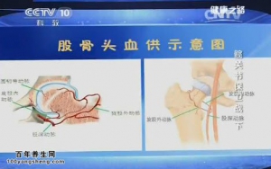 《健康之路》20150408视频笔记:股骨头坏死的原因及早期表现 股骨头坏死的治疗