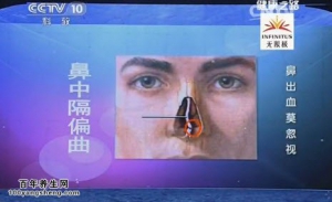 《健康之路》20150504视频笔记:鼻出血怎么办 鼻咽癌的早期表现 高血压为何会引发鼻出血