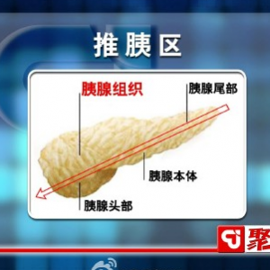 聚健康20150511视频和笔记:付国兵讲《“拿捏”健康生活-6》预防和控制糖尿病
