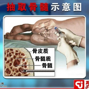 聚健康20150520视频和笔记:白血病的症状 急性白血病和慢性白血病的区别