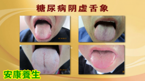 《养生堂》20150528视频笔记:韩学杰讲《由表及里话健康—2》糖尿病在手、舌、面上的表现