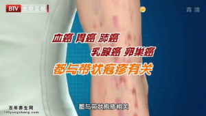 我是大医生20150528视频和笔记:糖尿病的征兆 尿毒症的征兆 癌症征兆