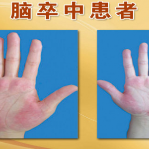 《养生堂》20150529视频笔记:韩学杰讲《由表及里话健康-3》脑卒中的前兆表现