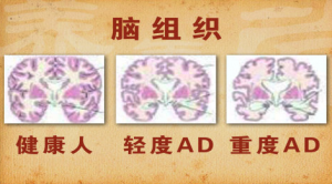 《养生堂》20150605视频笔记:刘梅林讲《吃出来的健康危机—2》老年性脑病的预防