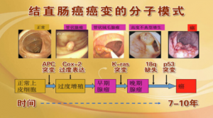 《养生堂》20150608视频笔记:肠癌的预防 结直肠癌变 息肉癌变 息肉的高危人群