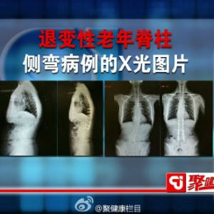 聚健康20150610视频和笔记:王宇讲保护身体的“顶梁柱”第二集