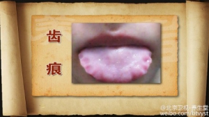 《养生堂》20150617视频和笔记:脾气虚的症状 脾胃功能失常的调理 艾灸减肥的方法