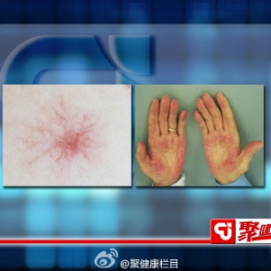 聚健康20150708:闫杰讲《伤肝那些事儿》