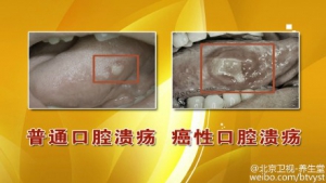 《养生堂》20150727视频笔记:《用牙“咬住”的生命-1》口腔癌 自制抑菌漱口水