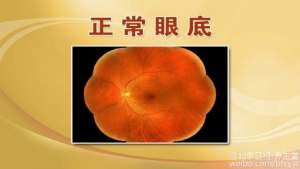 《养生堂》20150803视频笔记:《“看”出糖尿病》糖尿病视网膜病变 眼底出血