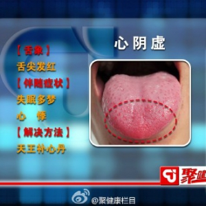 聚健康20150814：《望舌辨体质》心阴虚、肺阴虚、肾阴虚、肝阴虚